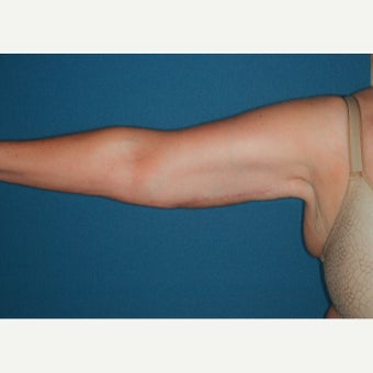 55-64 year old woman treated with Arm lift, brachioplasty. after 2280416