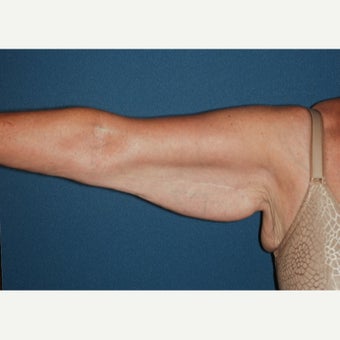 55-64 year old woman treated with Arm lift, brachioplasty. before 2280416