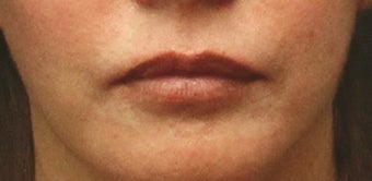 Lip Implant before 406789