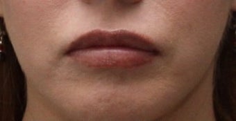 Lip Implant after 406789