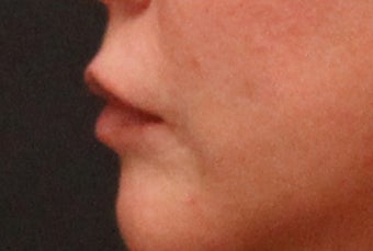Lip Implant 406789