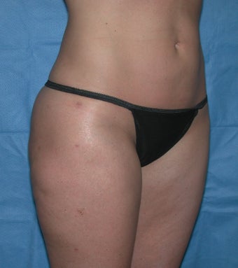 Laser Lipo and Cellulaze after 1367959