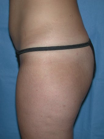 Laser Lipo and Cellulaze 1367959
