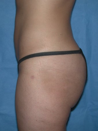 Laser Lipo and Cellulaze 1367959