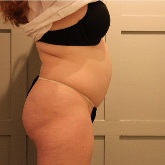 35-44 year old woman treated with CoolSculpting before 3069652