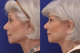 70 Year-old woman treated with Xeomin, Restylane, Face and Necklift, and Neck Suture Suspension. before 1221315