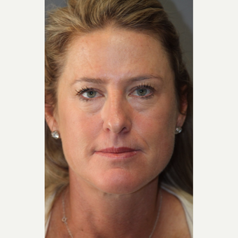 35-44 year old woman treated with Cheek Augmentation before 3141458