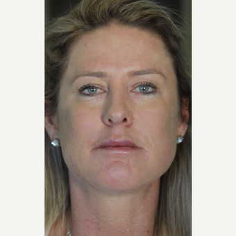 35-44 year old woman treated with Cheek Augmentation after 3141458