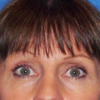 45-54 year old woman treated with Eyelid Surgery after 3497032