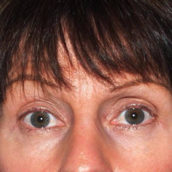 45-54 year old woman treated with Eyelid Surgery before 3497032