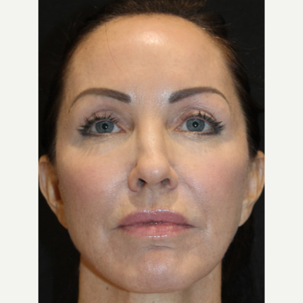 FRAX-SCULPT (CO2 Laser + Sculptra infused) after 3507812