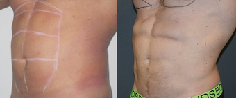 25-34 year old man treated with Vaser Liposuction before 4599322