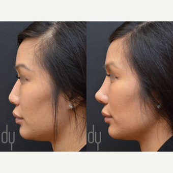 Revision Asian Rhinoplasty before 3477445