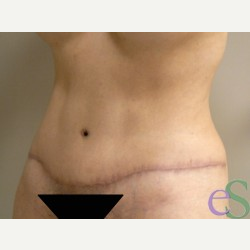 40 year old woman treated with Tummy Tuck after 3484918