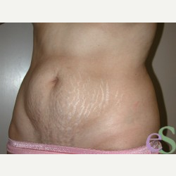 40 year old woman treated with Tummy Tuck before 3484918