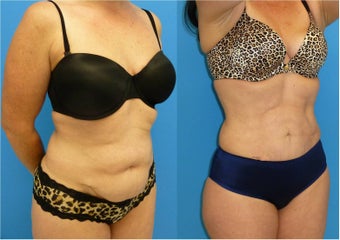 40 Year Old Female - Liposuction after 1077108