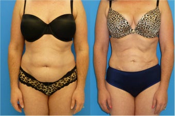 40 Year Old Female - Liposuction before 1077108