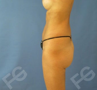 45-54 year old woman treated with Butt Implants + Fat Grafting 1897865