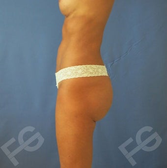 45-54 year old woman treated with Butt Implants + Fat Grafting 1897865