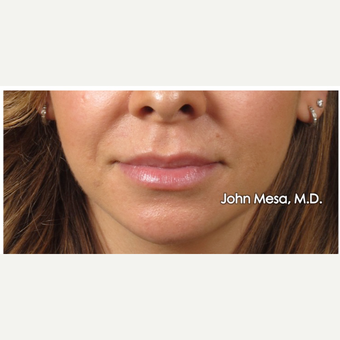 35-44 year old woman treated with Lip Augmentation before 3058428