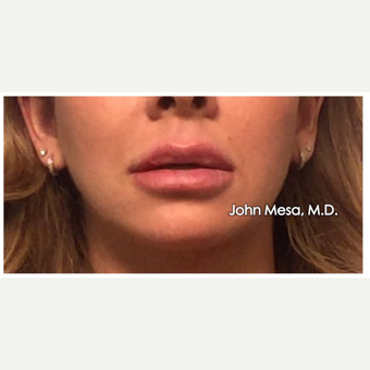35-44 year old woman treated with Lip Augmentation after 3058428