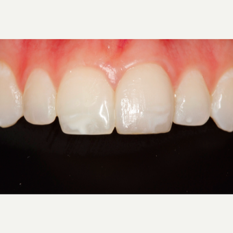 18-24 year old woman treated with Porcelain Veneers after 2696861