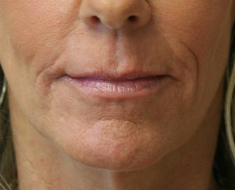 Juvederm in Nasal-labial folds after 675697