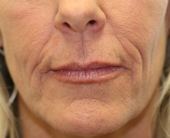 Juvederm in Nasal-labial folds before 675697
