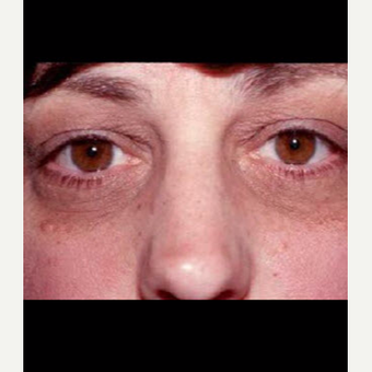 55-64 year old woman treated with Laser Treatment before 3711339