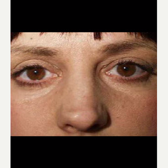 55-64 year old woman treated with Laser Treatment after 3711339