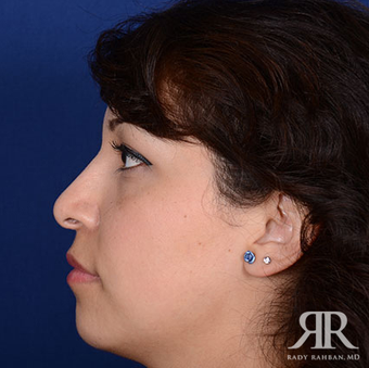Rhinoplasty after 1357427
