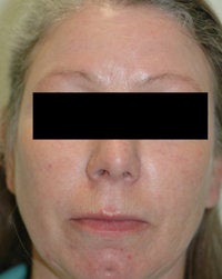 Laser Treatments for Rosacea after 104180