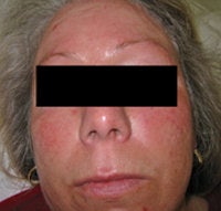 Laser Treatments for Rosacea before 104180