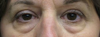 Eyelid surgery and mid-face lift before 1307529