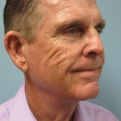 65-74 year old man treated with Neck Lift after 3722223