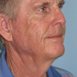 65-74 year old man treated with Neck Lift before 3722223