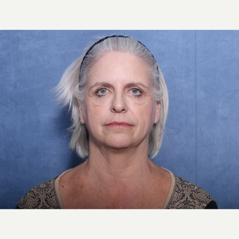 55-64 year old woman treated with Brow Lift before 3180140