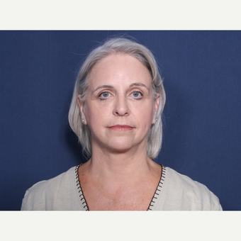 55-64 year old woman treated with Brow Lift after 3180140