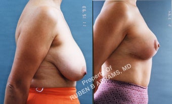 49 year-old female, full anchor breast reduction after 986984