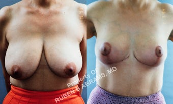 49 year-old female, full anchor breast reduction before 986984