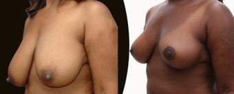 African American Breast Reduction before 1141925