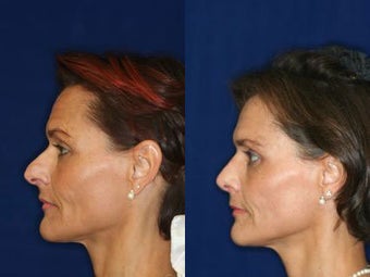 Rhinoplasty before 229781
