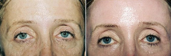 Chemical Peel before 1431800
