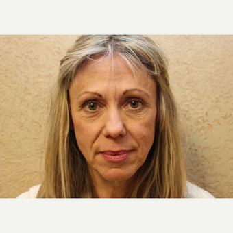 Facelift before 3454845