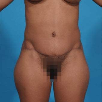 25-34 year old woman treated with Tummy Tuck after 1851222