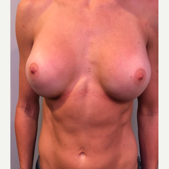 25-34 year old woman treated with Breast Augmentation after 3530447