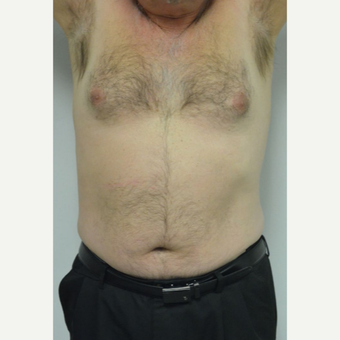 55-64 year old man treated with Male Breast Reduction before 3054074