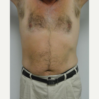 55-64 year old man treated with Male Breast Reduction after 3054074
