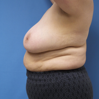 65-74 year old woman treated with Breast Reduction before 3087415