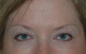 Botox Treatment after 94106